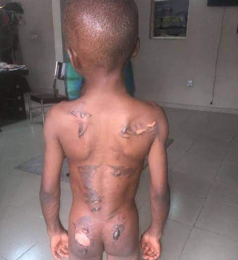  Starving boy scarred with hot iron by aunt over N50 nuts