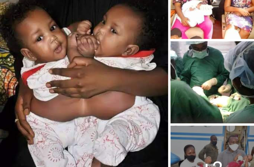  Landmark: FMC Yola Separates Another Conjoined Twins successfully