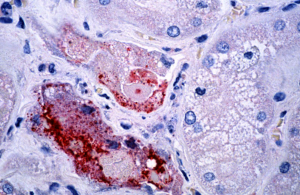 nipah-virus-infection-in-this-case-affecting-an-unknown-animals-kidney-tubules