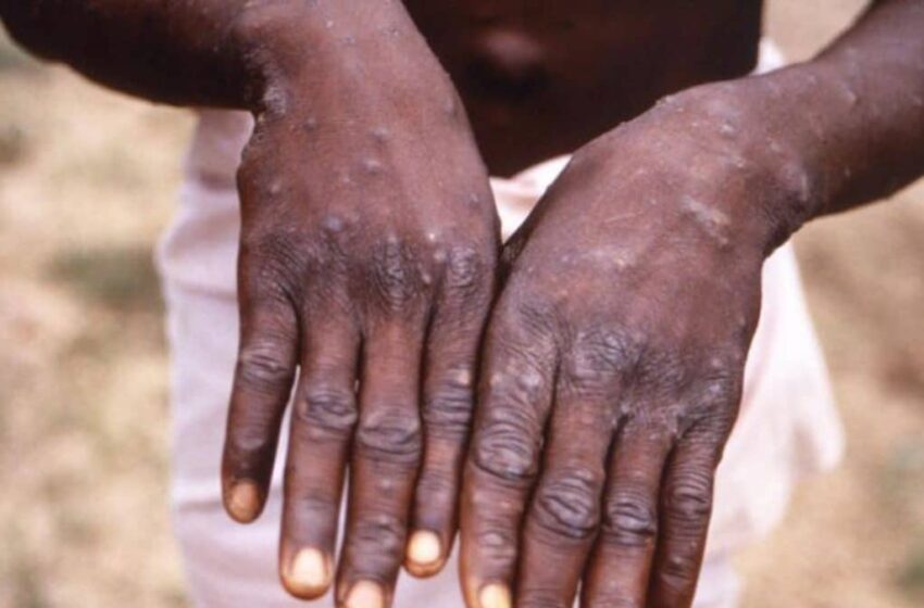  NCDC records 66 monkeypox suspected cases, one death