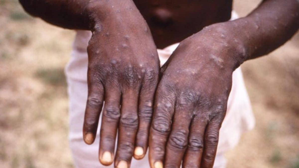 monkeypox